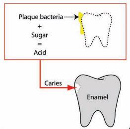 caries overview